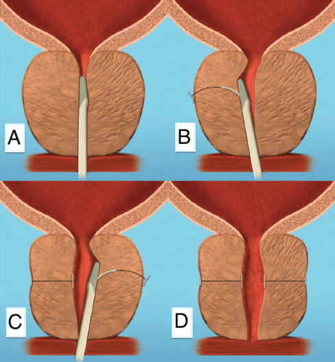 Image: Pictorial depiction of a Prostatic Urethral Lift (PUL) procedure. Source: Garcia C, Chin P, Rashid P, Woo HH. Prostatic urethral lift: A minimally invasive treatment for benign prostatic hyperplasia. Prostate Int. 2015;3(1):1-5. doi:10.1016/j.prnil.2015.02.002